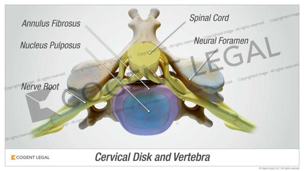 Cervical Disc and Vertebra