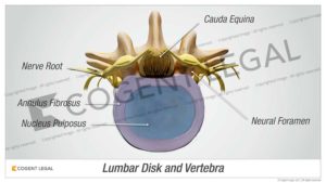 Lumbar Disk and Vertebra