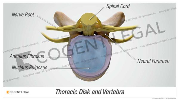 Thoracic Disk and Vertebra